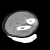 SPORK, NICO - 22.03.1976 - 02.08.2022 - CT obere Extremität - 17:56:57